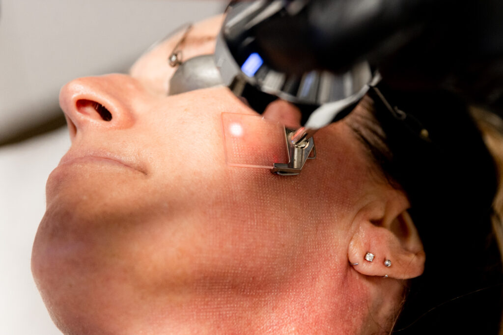 Renova Aesthetics ProFractional Laser