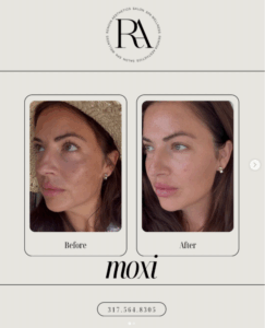 Before and after MOXI laser treatment showing improved tone and texture.