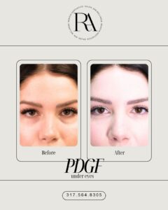 2-Week Under-Eye Transformation with PDGF Injections!