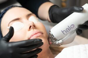Woman with radiant, youthful skin during HALO laser treatment
